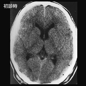 急性硬膜外血腫1