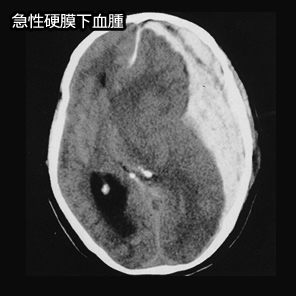 急性硬膜下血腫