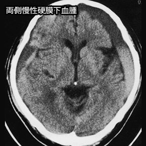 両側慢性硬膜下血腫