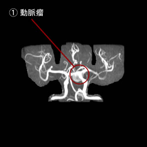 未破裂脳動脈瘤1