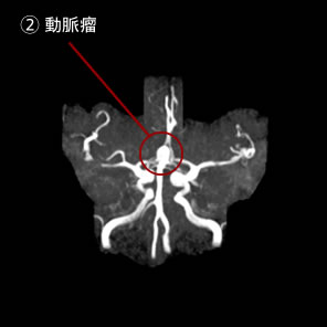 未破裂脳動脈瘤2