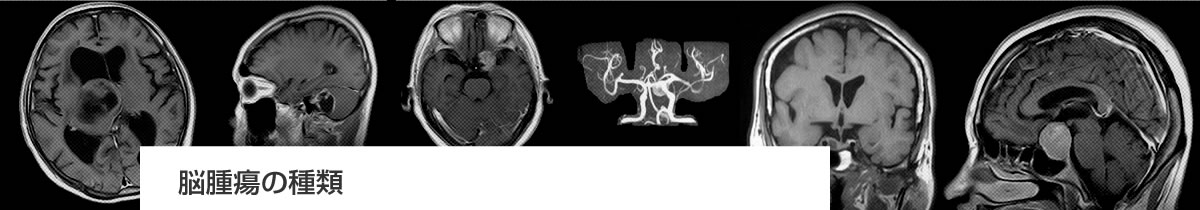 脳腫瘍の種類